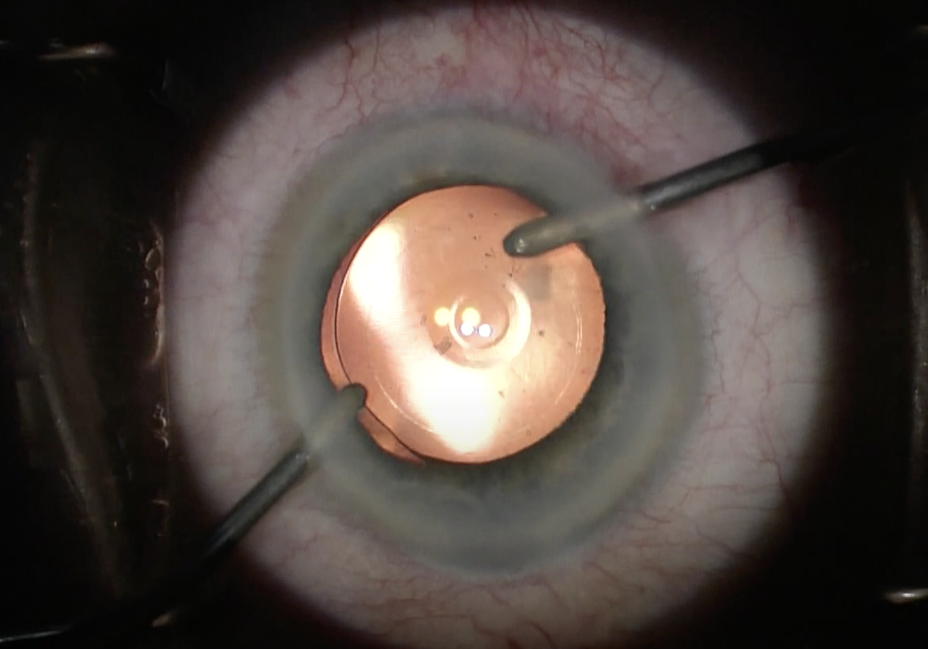 Epiretinal Membrane Top Complication Of Iol Replacement 